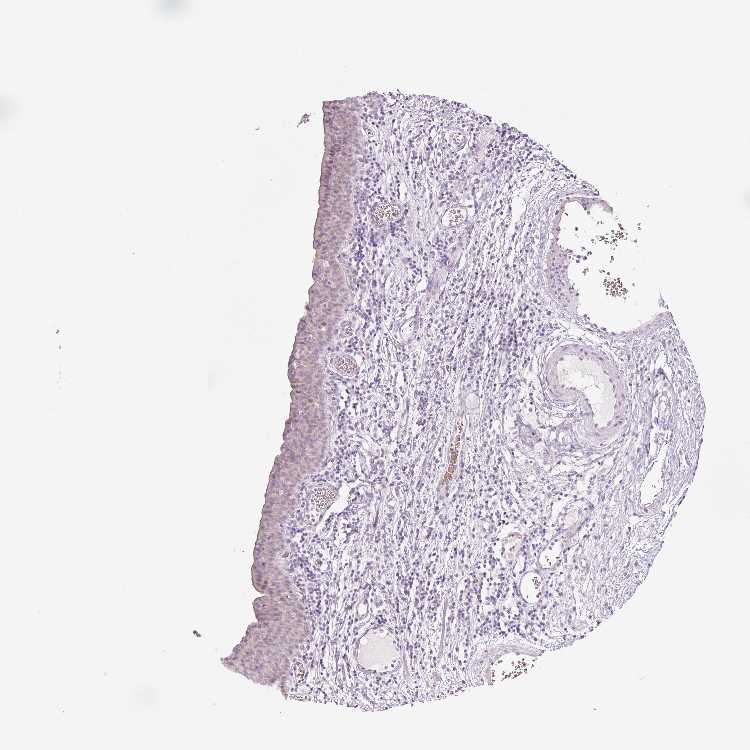 tissue fragments in urine